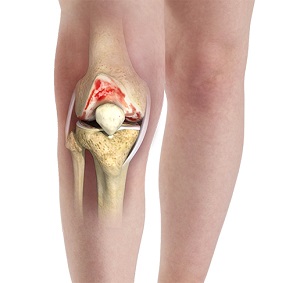 Exacerbation of Knee Arthritis (Osteoarthritic Flare)