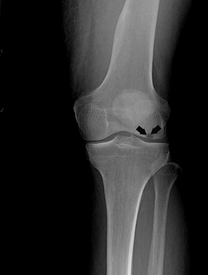 Osteonecrosis of the Knee